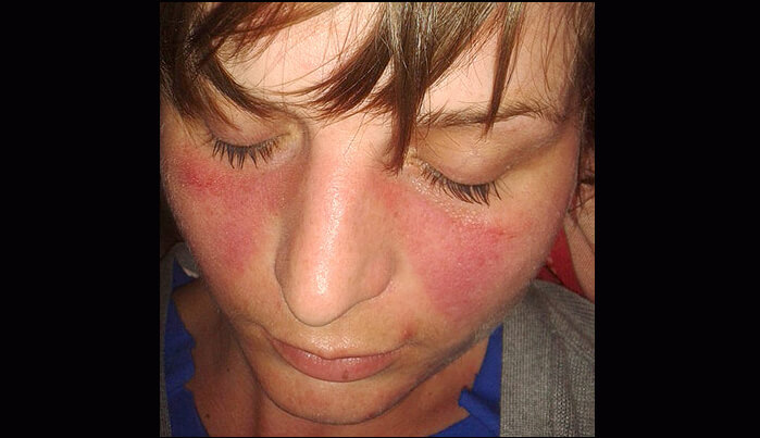 لوپوس اریتماتوز چیست